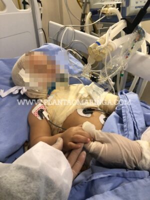 Criança sofre queimaduras graves com óleo quente em Maringá, e é transferida para hospital especializado em queimados Foto 1 Fotos de Criança sofre queimaduras graves com óleo quente em Maringá, e é transferida para hospital especializado em queimados