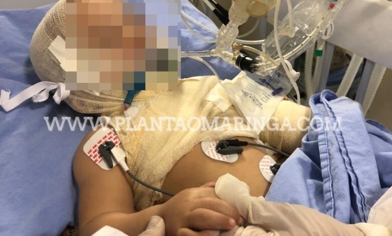 Fotos de Criança sofre queimaduras graves com óleo quente em Maringá, e é transferida para hospital especializado em queimados