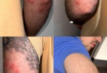 Fotos de Percevejos atacam passageiros em ônibus leito-cama em linhas de Maringá