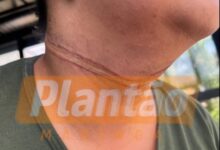 Fotos de Câmera registra jovem que teve o pescoço enroscado em fiação solta em Maringá