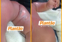 Fotos de Bebê de 8 meses sofre queimaduras graves após princípio de incêndio em chuveiro de CMEI em Sarandi