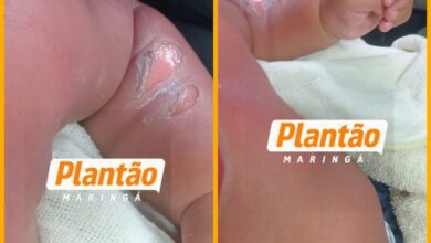 Fotos de Bebê de 8 meses sofre queimaduras graves após princípio de incêndio em chuveiro de CMEI em Sarandi