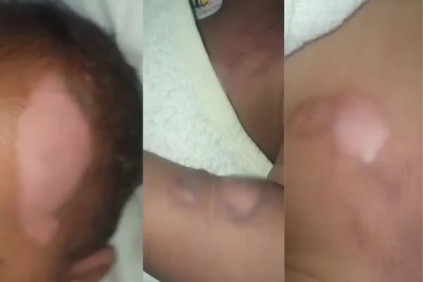 Mãe atualiza estado de saúde de bebê de 9 meses que sofreu queimaduras graves em creche e segue internado no HU de Maringá Foto 1 Fotos de Mãe atualiza estado de saúde de bebê de 9 meses que sofreu queimaduras graves em creche e segue internado no HU de Maringá