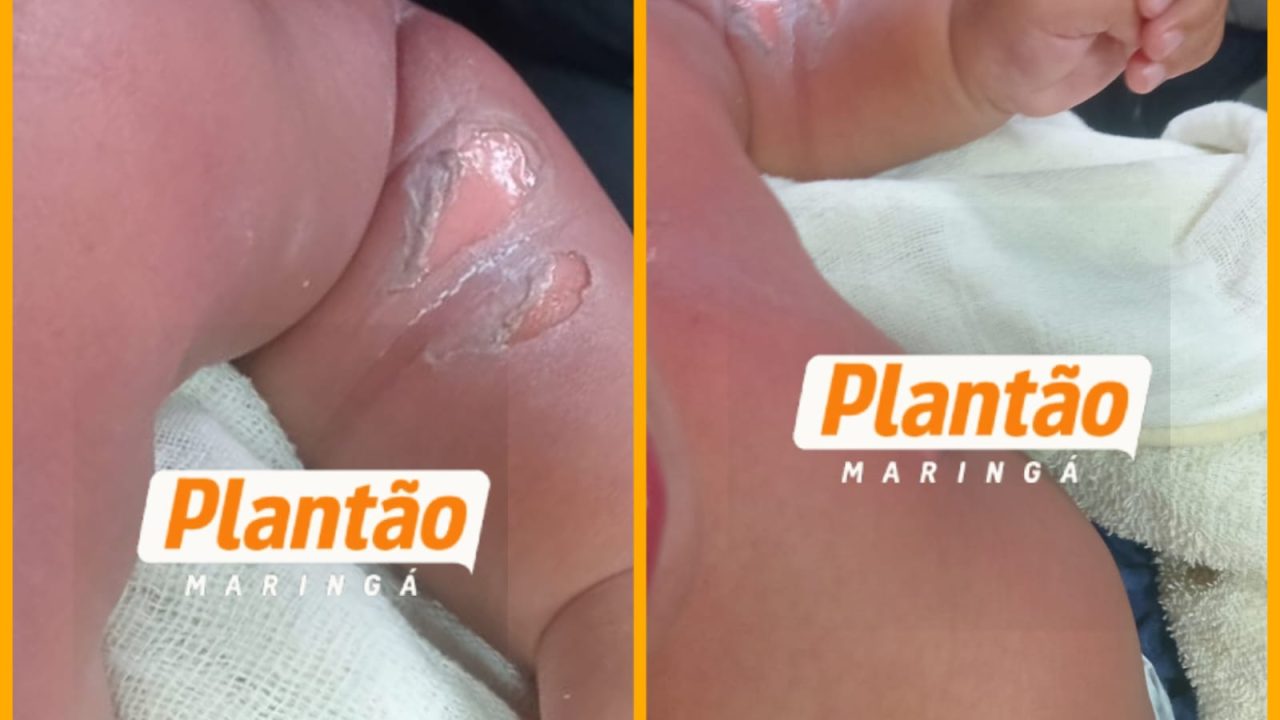 bebe-de-8-meses-sofre-queimaduras-graves-apos-principio-de-incendio-em-chuveiro-de-cmei-em-sarandi